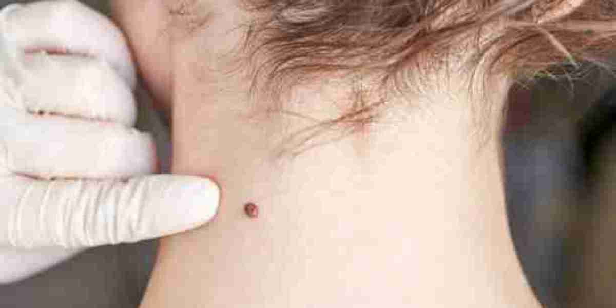 Mole Removal for Early Skin Issue Detection