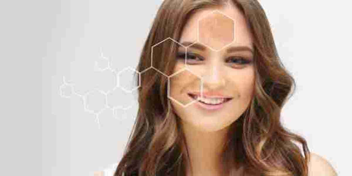 Melasma Treatment for Brighter and Healthier Skin