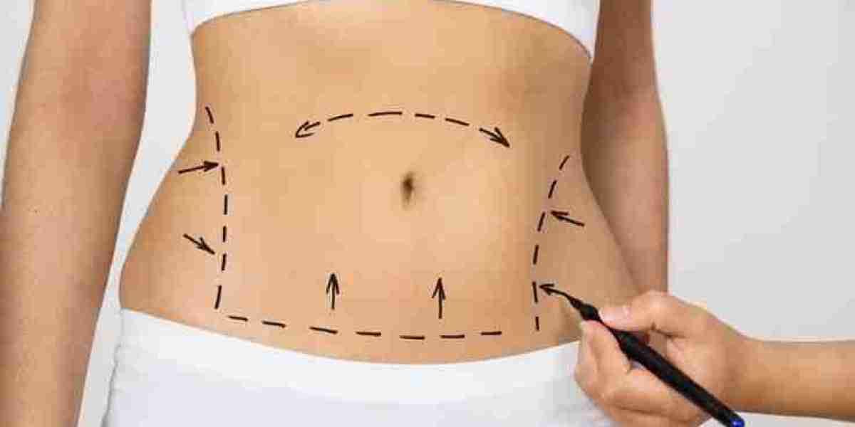 Liposuction and Modern Fat Removal Techniques Explained