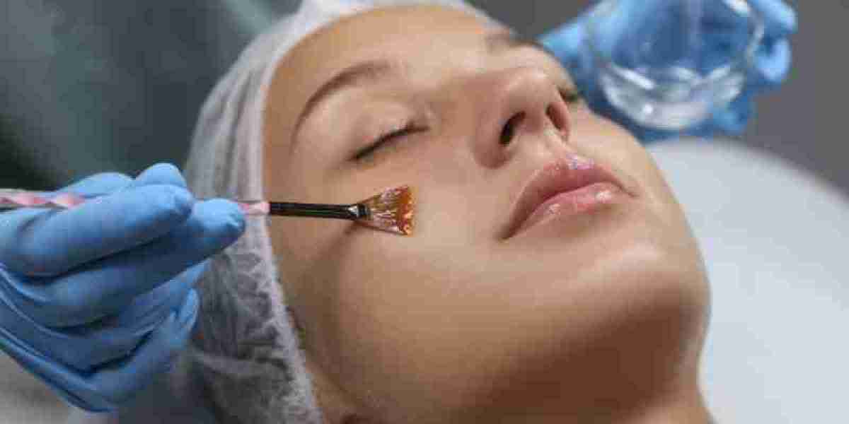 Top 10 Benefits of Getting a Chemical Peel