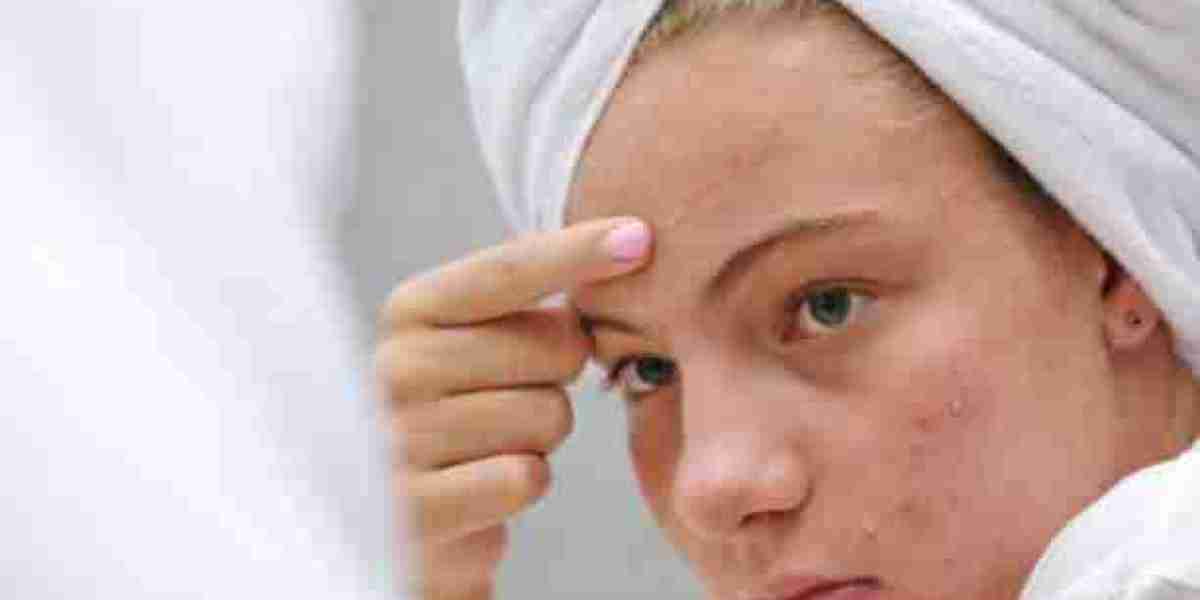 Dermatologist-Recommended Acne Treatment Insights