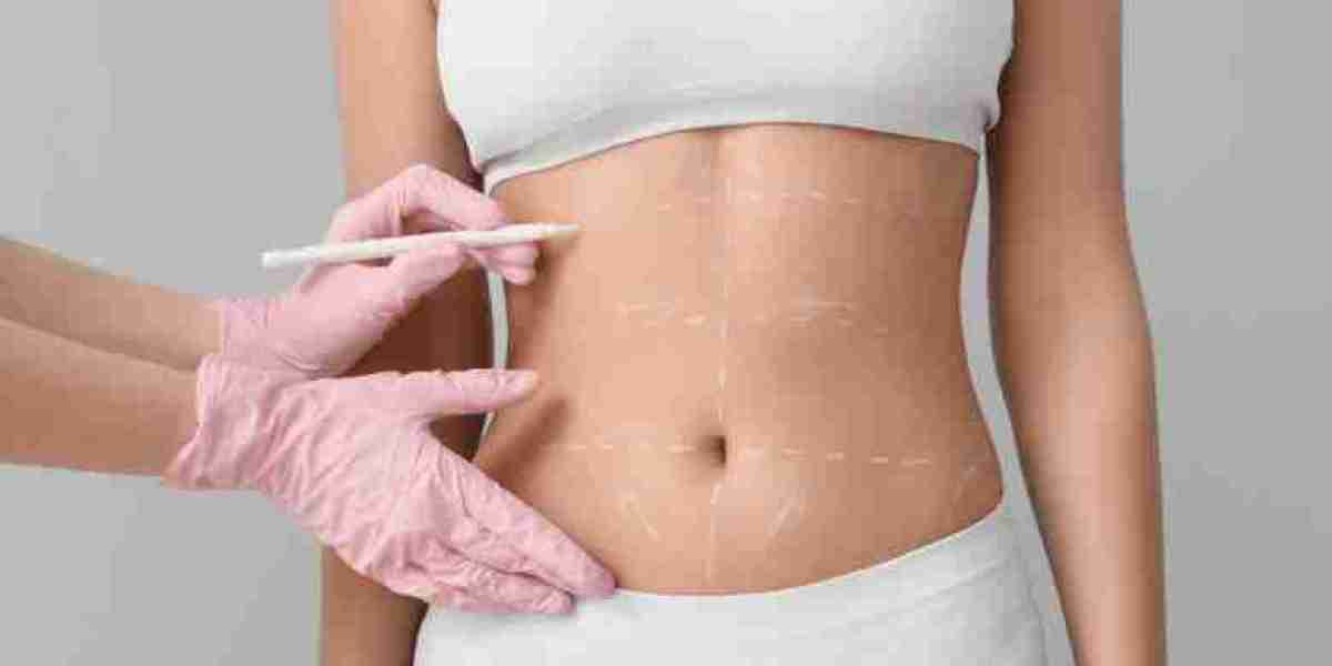 Liposuction Recovery: Tips for Faster Healing