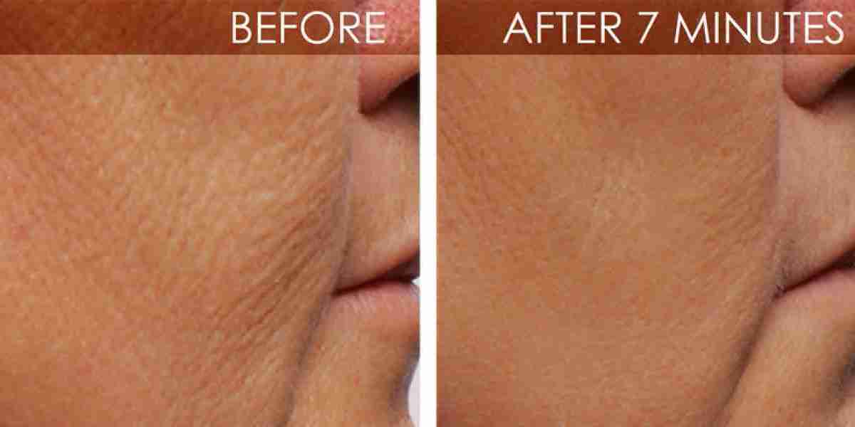 Einleitung: Micro Botox verstehen und moderne Hautpflege